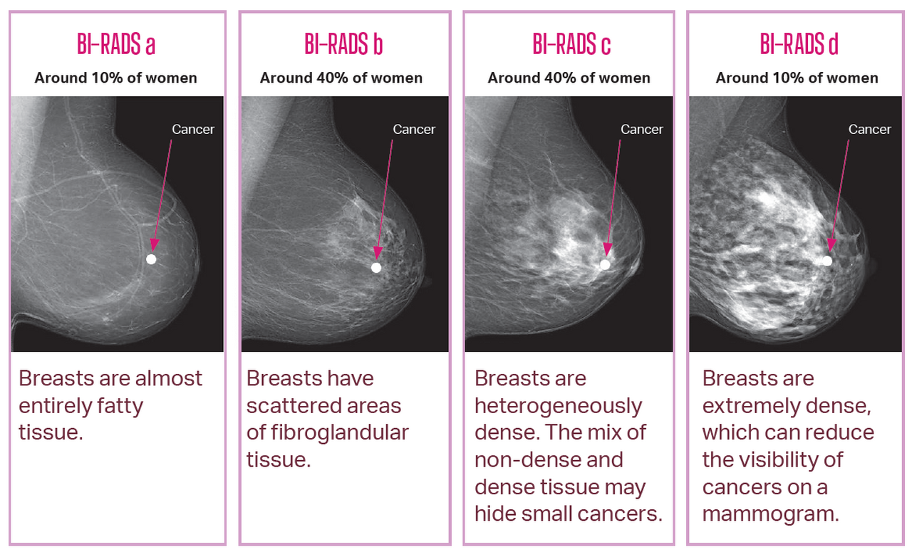 breastscreen-sa-breast-density