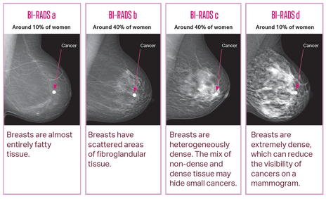 BreastScreen SA • Breast Density