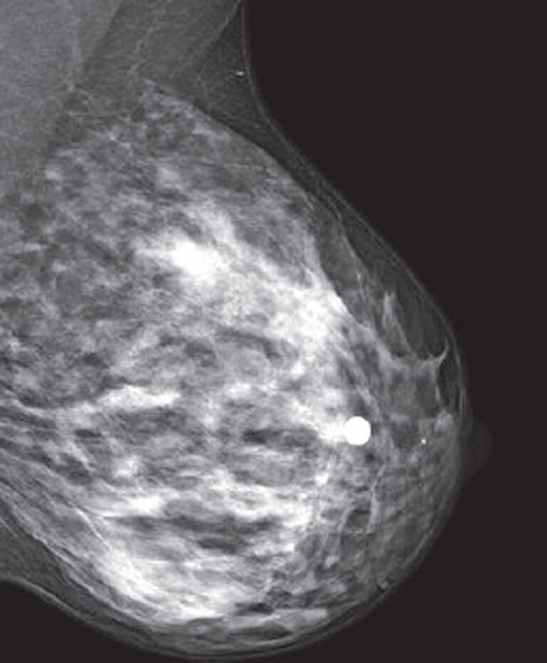 BreastScreen SA • Breast Cancer Screening